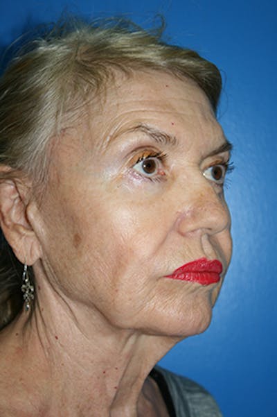Neck Lift Before & After Gallery - Patient 701575 - Image 1