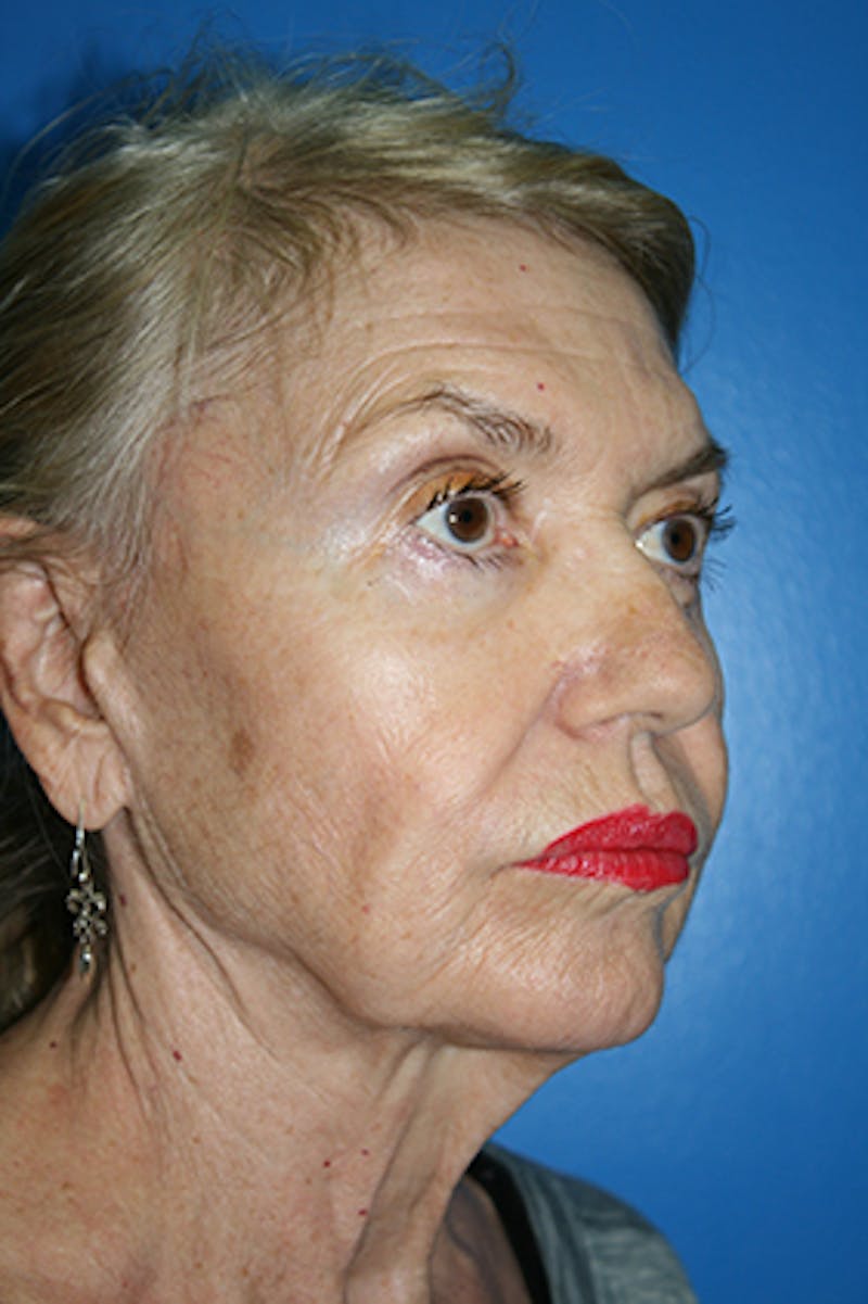 Deep Plane Facelift Before & After Gallery - Patient 407398 - Image 1