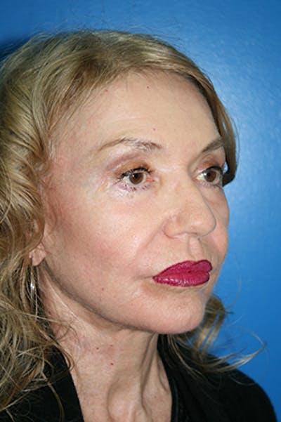 Neck Lift Before & After Gallery - Patient 701575 - Image 2