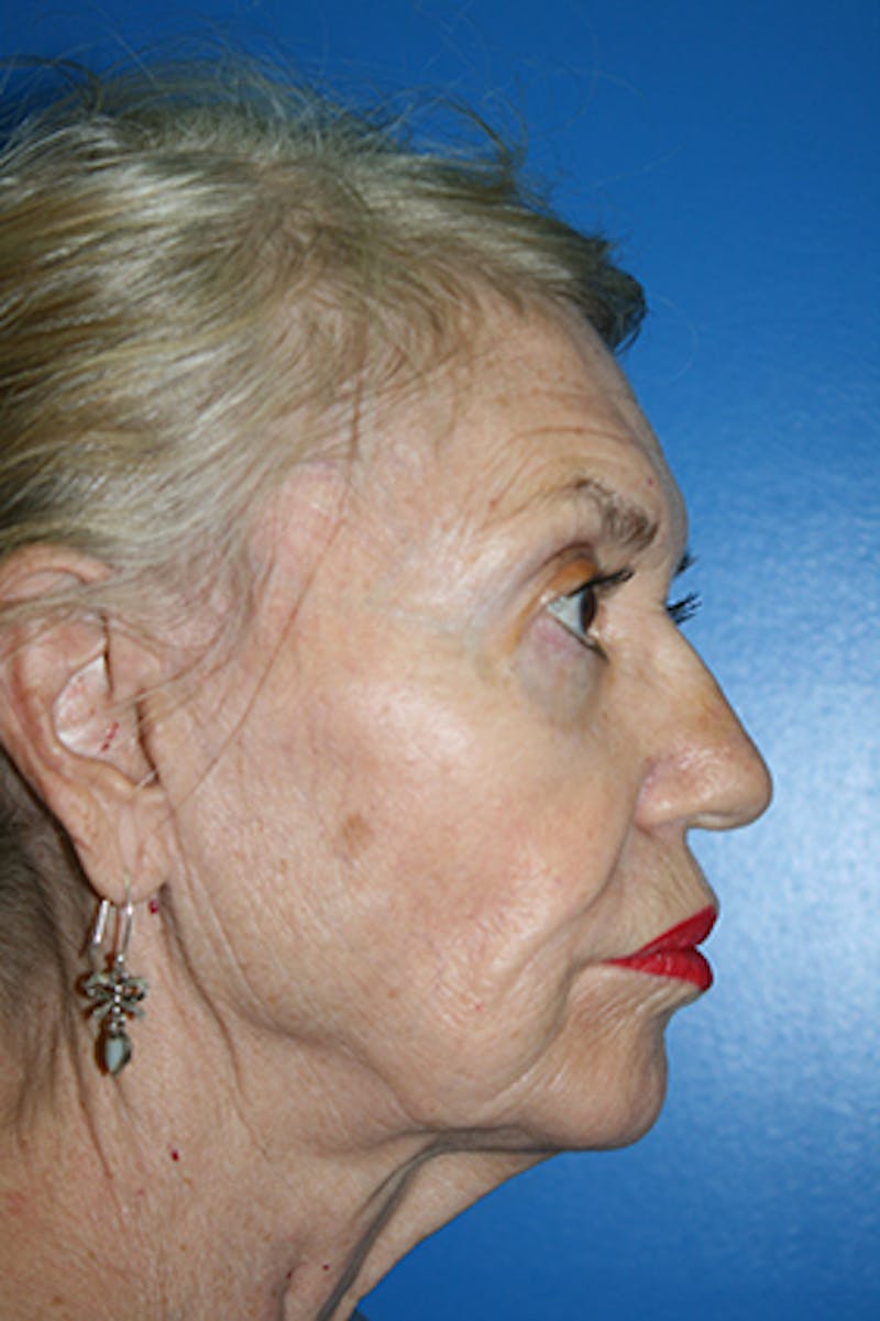 Deep Plane Facelift Before & After Gallery - Patient 407398 - Image 3