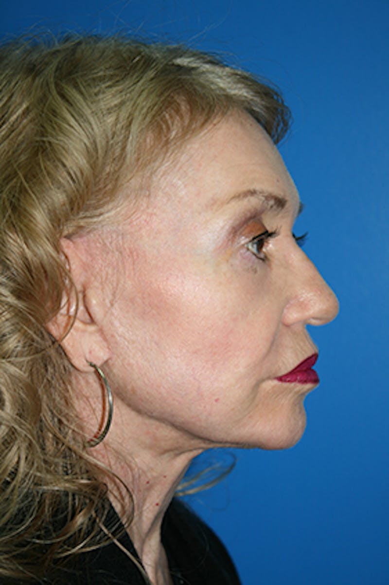 Deep Plane Facelift Before & After Gallery - Patient 407398 - Image 4