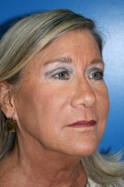 Neck Lift Before & After Gallery - Patient 162082 - Image 1