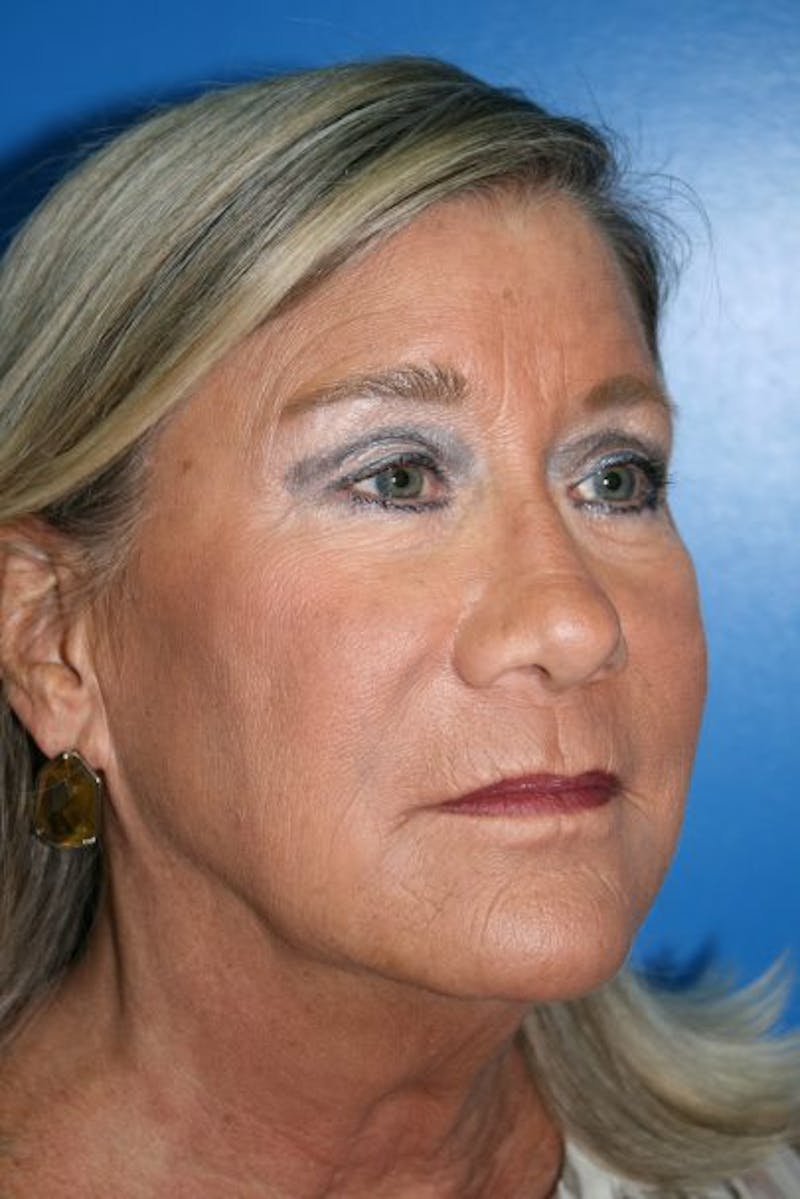 Deep Plane Facelift Before & After Gallery - Patient 328031 - Image 1