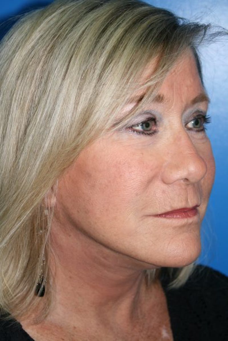 Deep Plane Facelift Before & After Gallery - Patient 328031 - Image 2