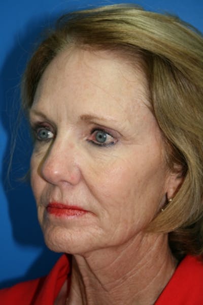 Neck Lift Before & After Gallery - Patient 390154 - Image 1