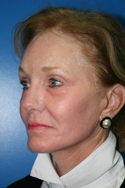 Neck Lift Before & After Gallery - Patient 390154 - Image 2