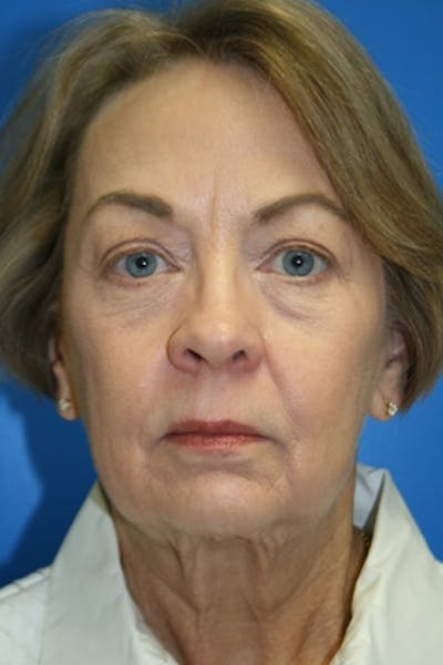 Neck Lift Before & After Gallery - Patient 173027 - Image 1