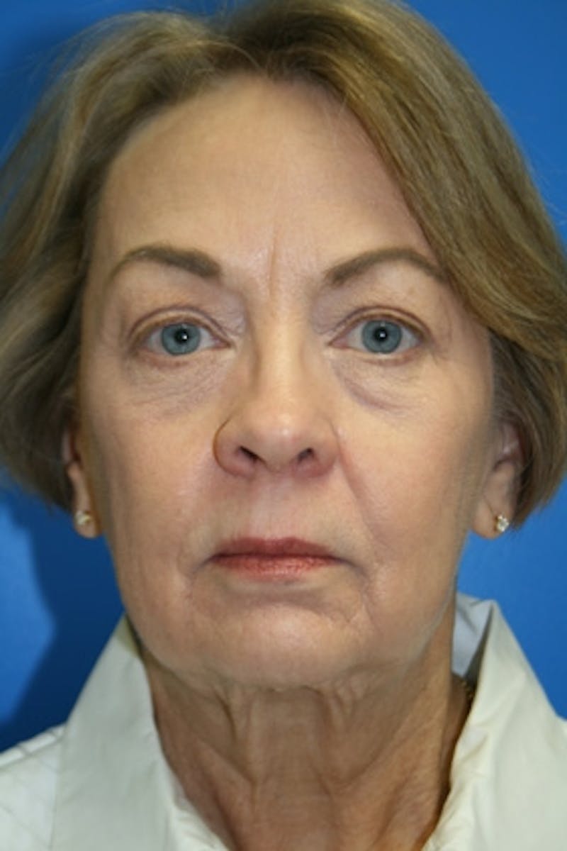 Deep Plane Facelift Before & After Gallery - Patient 180620 - Image 1