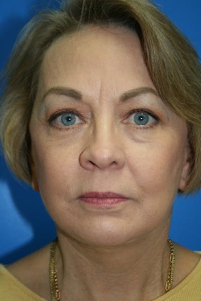 Neck Lift Before & After Gallery - Patient 173027 - Image 2
