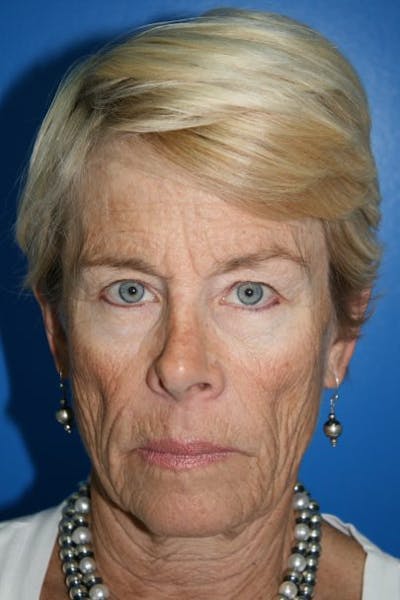 Neck Lift Before & After Gallery - Patient 299444 - Image 1