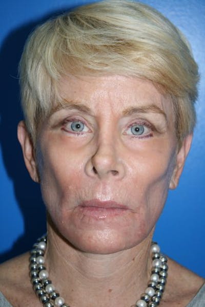 Neck Lift Before & After Gallery - Patient 299444 - Image 2