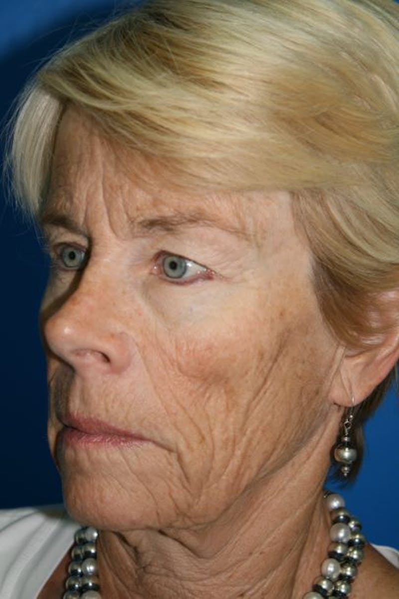 Deep Plane Facelift Before & After Gallery - Patient 342746 - Image 3