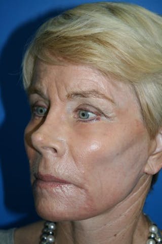 Deep Plane Facelift Before & After Gallery - Patient 342746 - Image 4