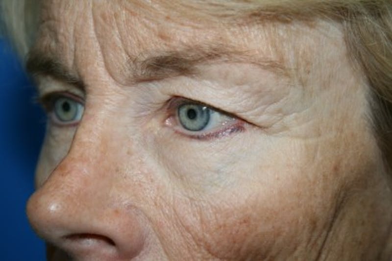 Deep Plane Facelift Before & After Gallery - Patient 342746 - Image 5