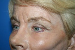 Deep Plane Facelift Before & After Gallery - Patient 342746 - Image 6