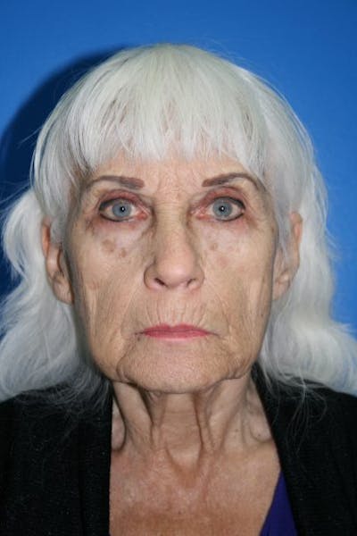 Neck Lift Before & After Gallery - Patient 185422 - Image 1