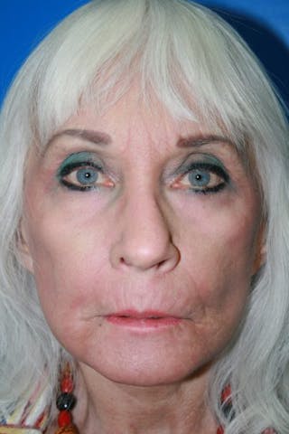 Deep Plane Facelift Before & After Gallery - Patient 418231 - Image 2