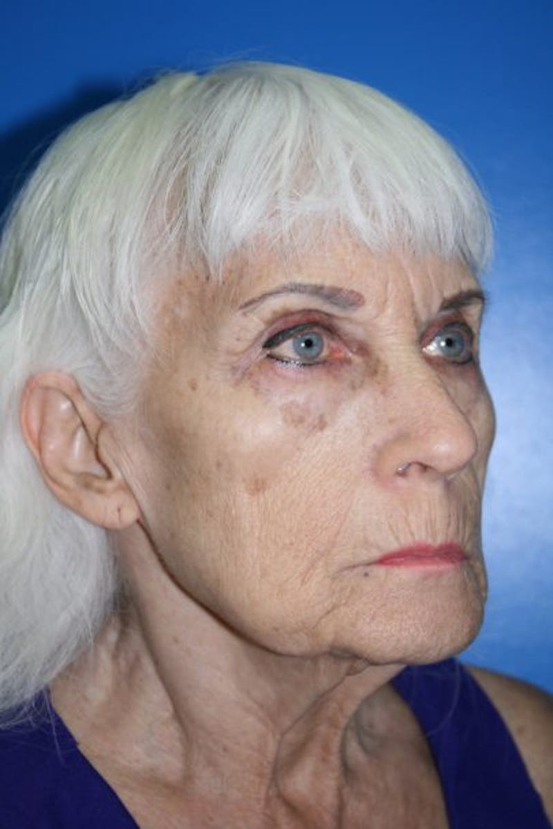 Deep Plane Facelift Before & After Gallery - Patient 418231 - Image 3
