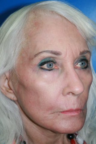 Deep Plane Facelift Before & After Gallery - Patient 418231 - Image 4
