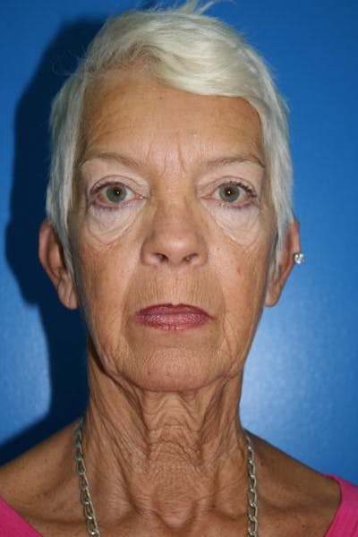 Neck Lift Before & After Gallery - Patient 189332 - Image 1