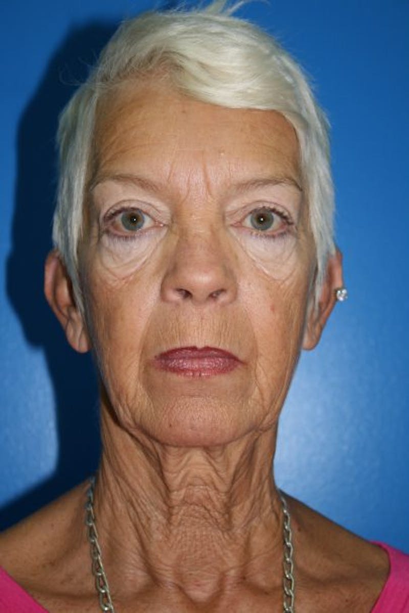 Deep Plane Facelift Before & After Gallery - Patient 382200 - Image 1