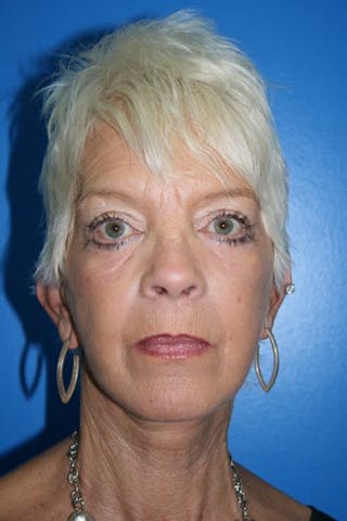 Deep Plane Facelift Before & After Gallery - Patient 382200 - Image 2