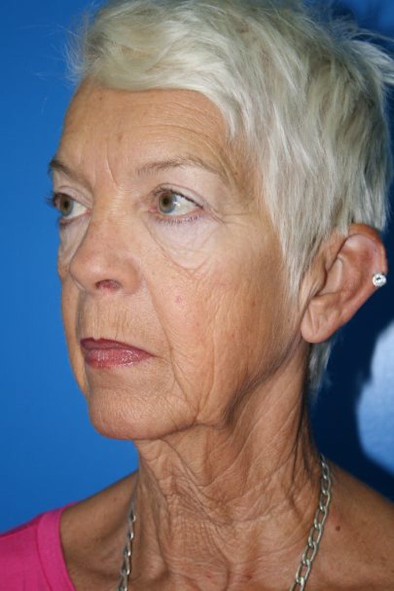 Deep Plane Facelift Before & After Gallery - Patient 382200 - Image 3