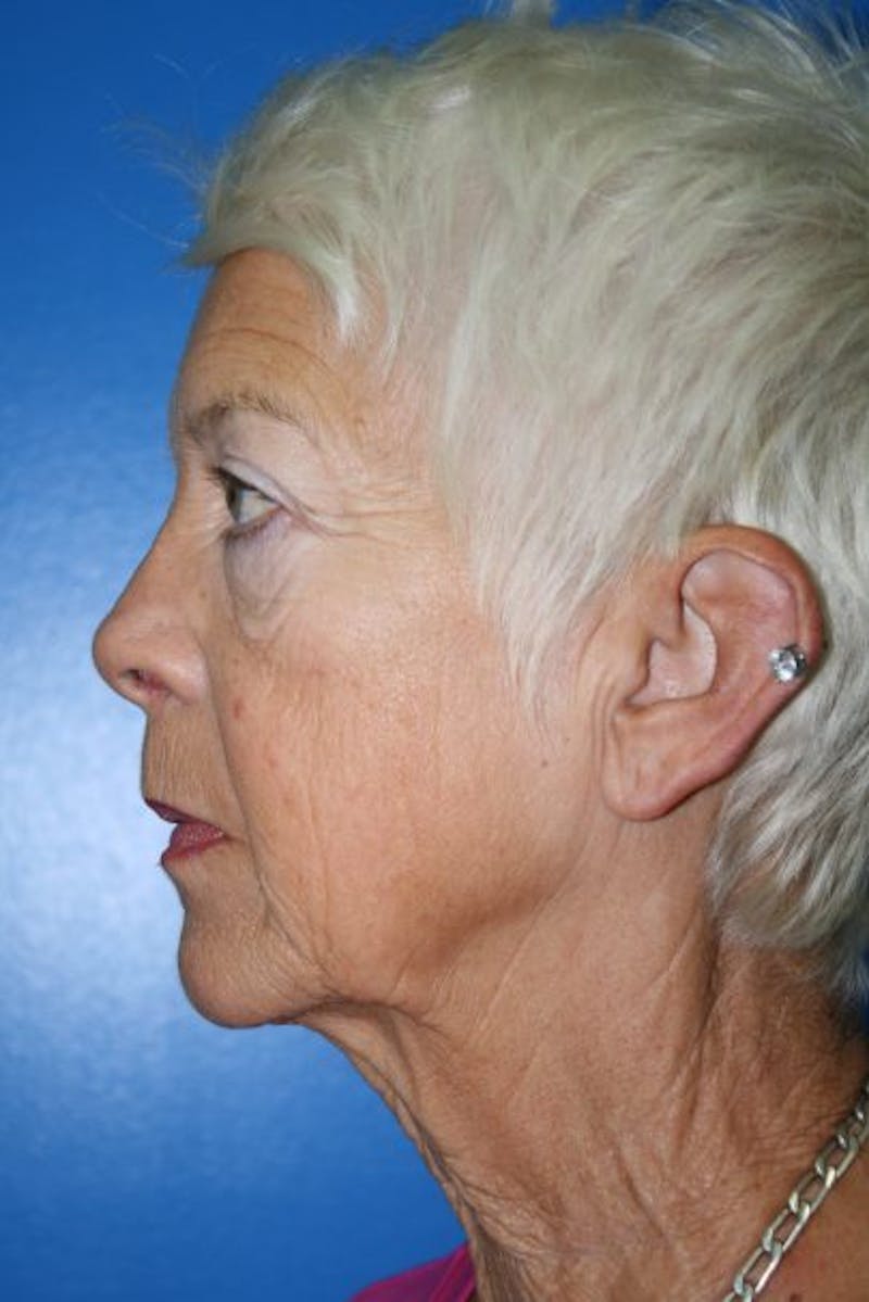 Deep Plane Facelift Before & After Gallery - Patient 382200 - Image 5