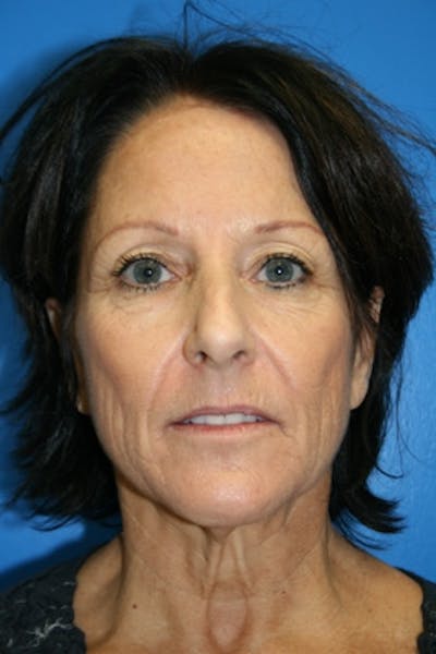 Neck Lift Before & After Gallery - Patient 284971 - Image 1