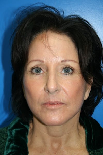 Neck Lift Before & After Gallery - Patient 284971 - Image 2