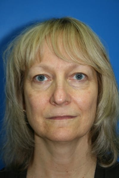Neck Lift Before & After Gallery - Patient 201674 - Image 1