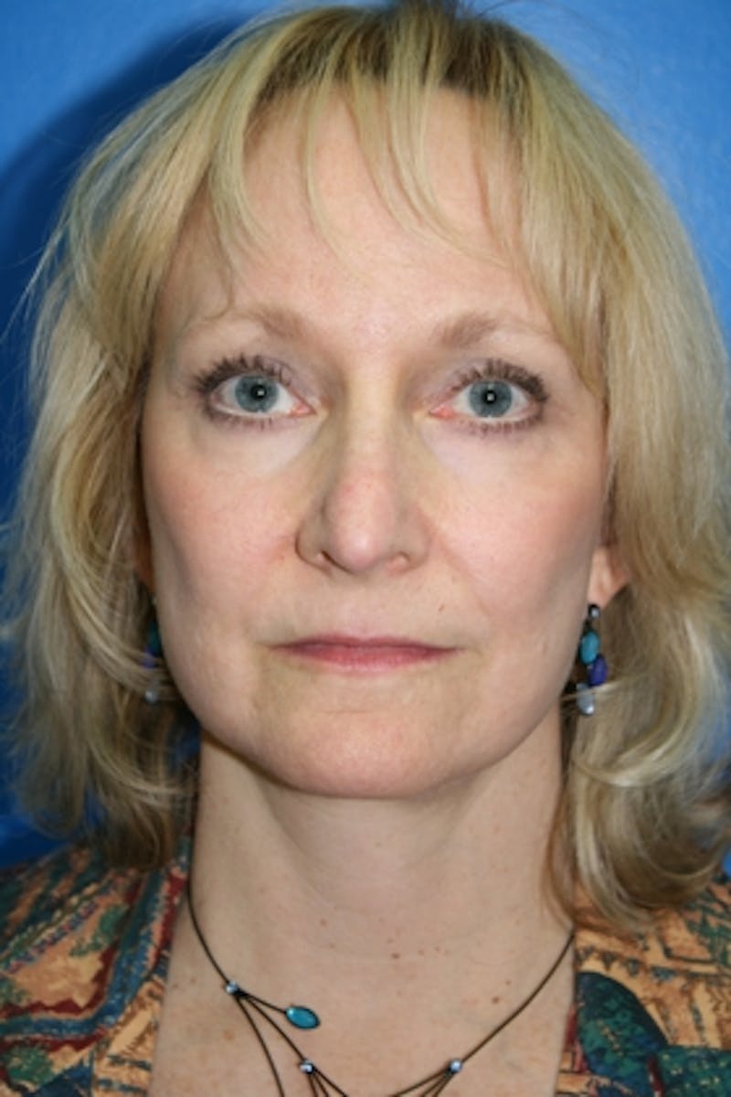 Deep Plane Facelift Before & After Gallery - Patient 189555 - Image 2
