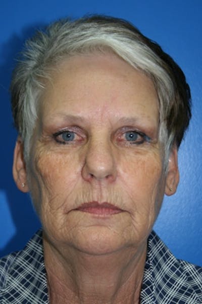 Neck Lift Before & After Gallery - Patient 396246 - Image 1