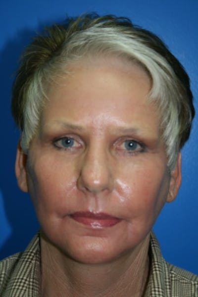 Neck Lift Before & After Gallery - Patient 396246 - Image 2