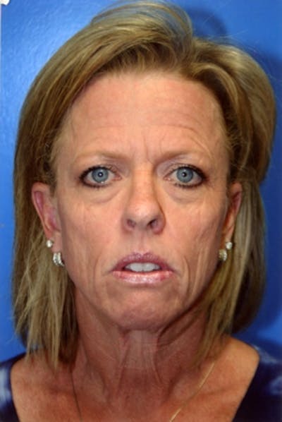 Neck Lift Before & After Gallery - Patient 339196 - Image 1