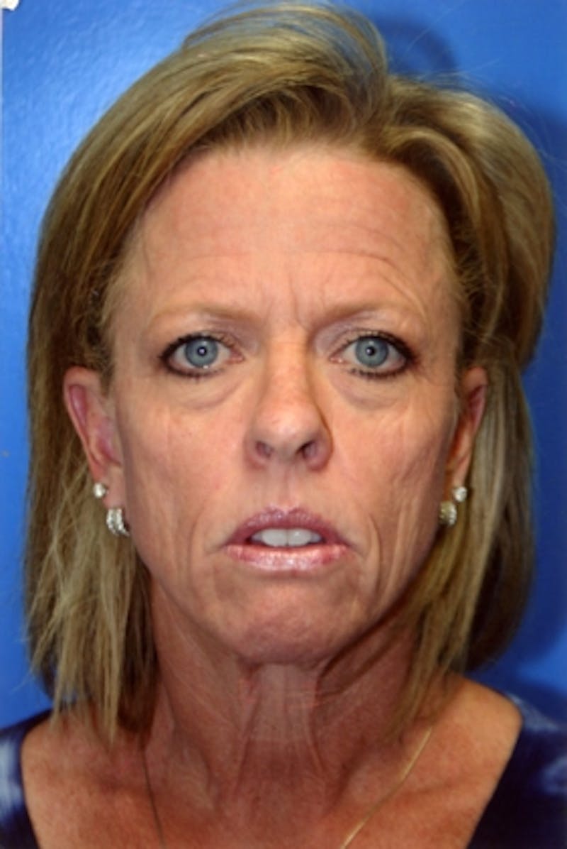 Deep Plane Facelift Before & After Gallery - Patient 211500 - Image 1