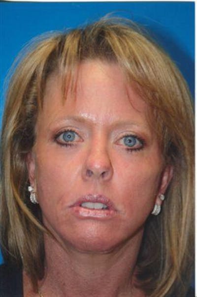 Neck Lift Before & After Gallery - Patient 339196 - Image 2