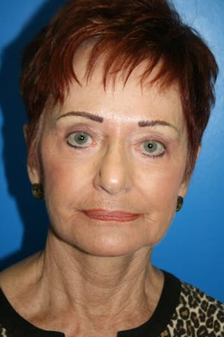 Eyelid Lift Before & After Gallery - Patient 369253 - Image 2