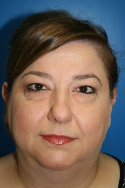 Eyelid Lift Before & After Gallery - Patient 212673 - Image 1