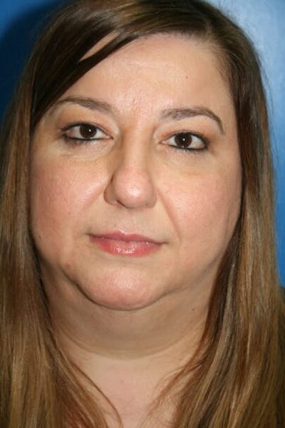Eyelid Lift Before & After Gallery - Patient 212673 - Image 2
