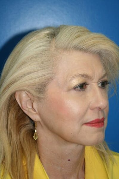 Eyelid Lift Before & After Gallery - Patient 380494 - Image 1