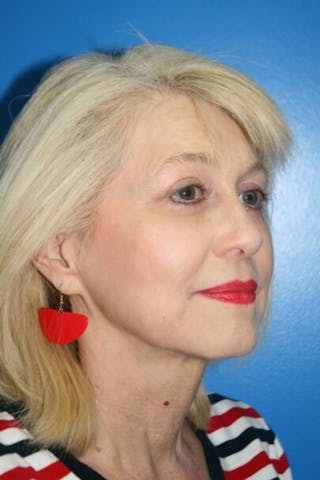 Eyelid Lift Before & After Gallery - Patient 380494 - Image 2