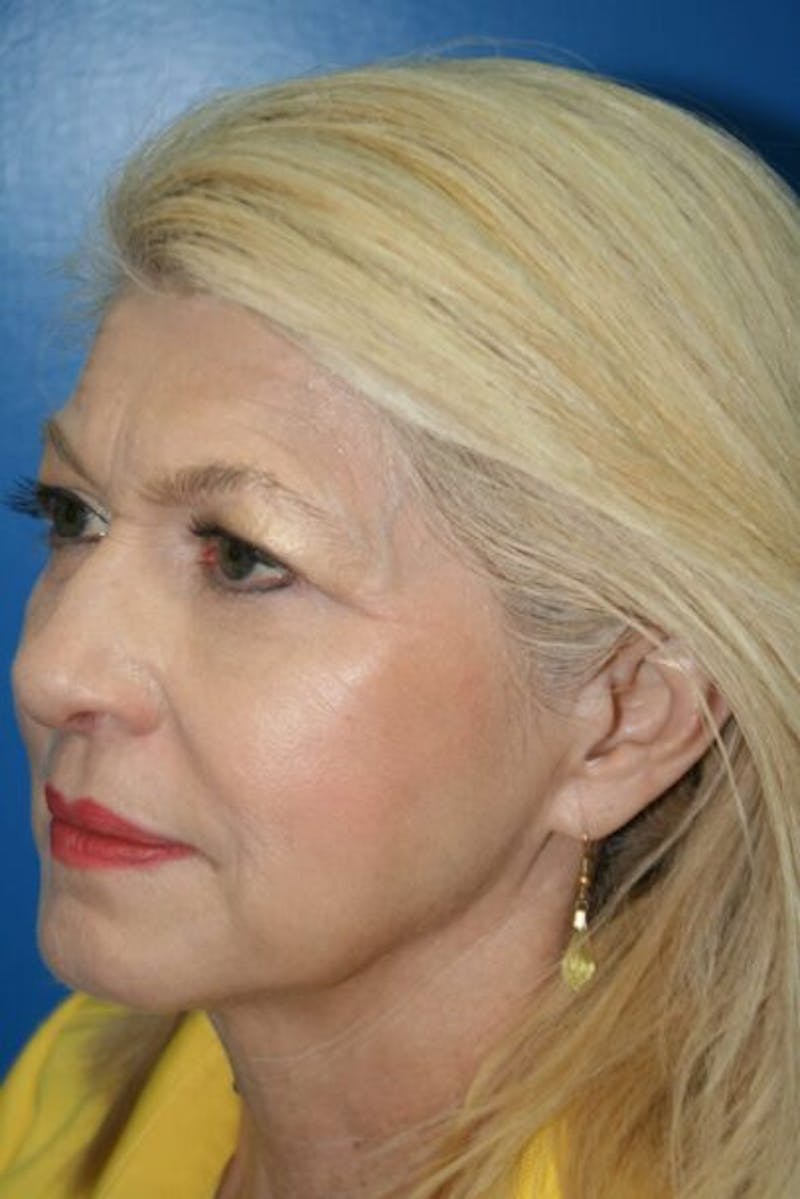 Eyelid Lift Before & After Gallery - Patient 380494 - Image 3