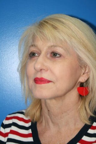 Eyelid Lift Before & After Gallery - Patient 380494 - Image 4