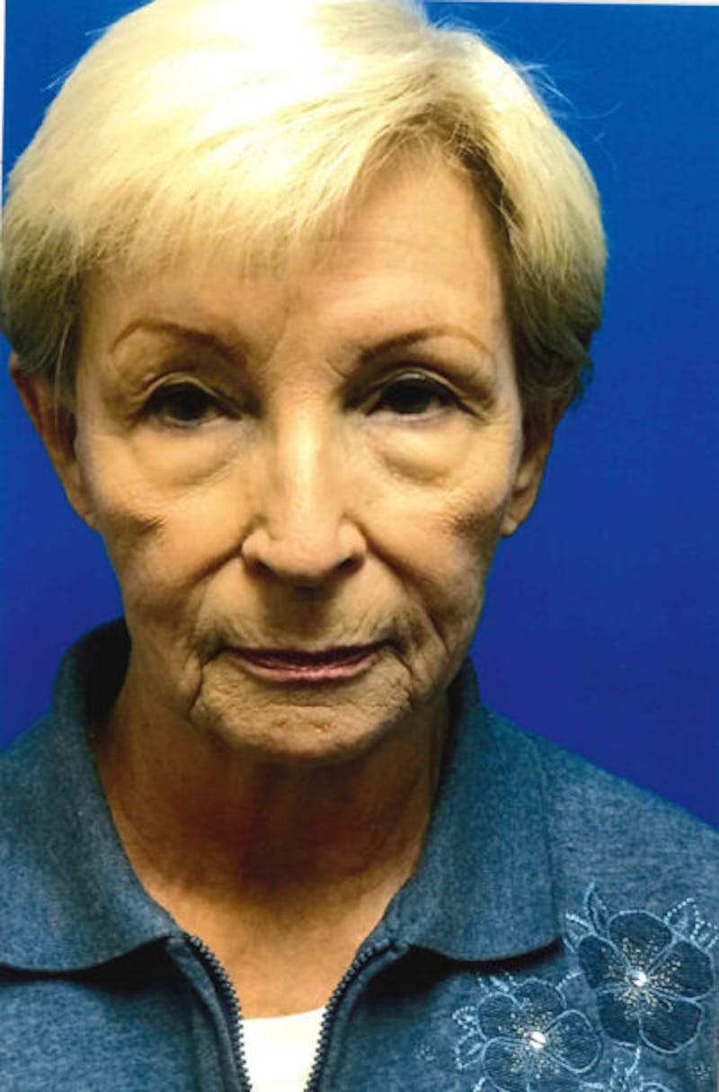 Eyelid Lift Before & After Gallery - Patient 167487 - Image 1