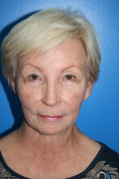 Eyelid Lift Before & After Gallery - Patient 167487 - Image 2