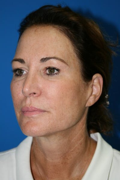 Eyelid Lift Before & After Gallery - Patient 219195 - Image 1