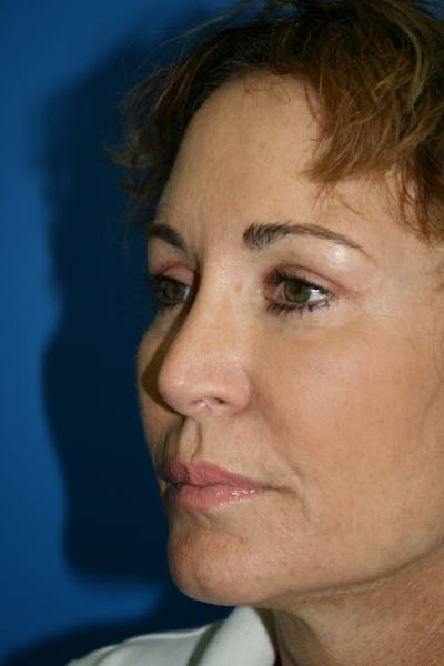 Eyelid Lift Before & After Gallery - Patient 219195 - Image 2