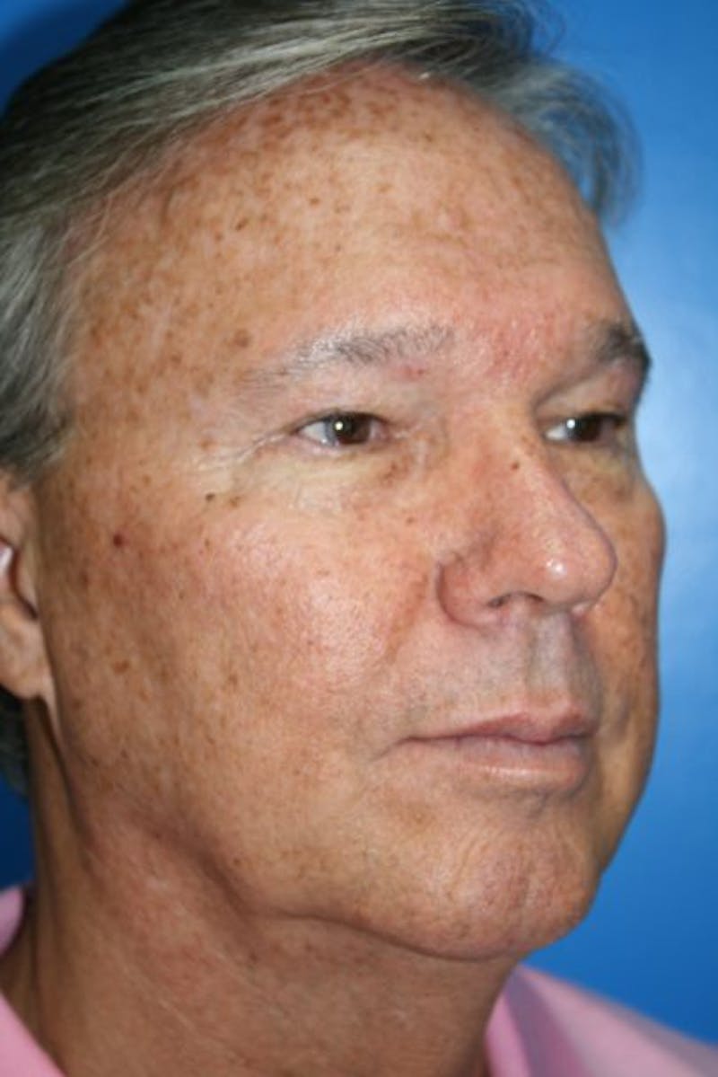 Eyelid Lift Before & After Gallery - Patient 187263 - Image 1