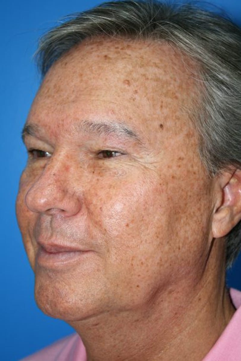 Eyelid Lift Before & After Gallery - Patient 187263 - Image 3